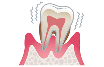 歯周病が及ぼす全身への影響