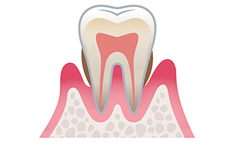 歯周病予防について